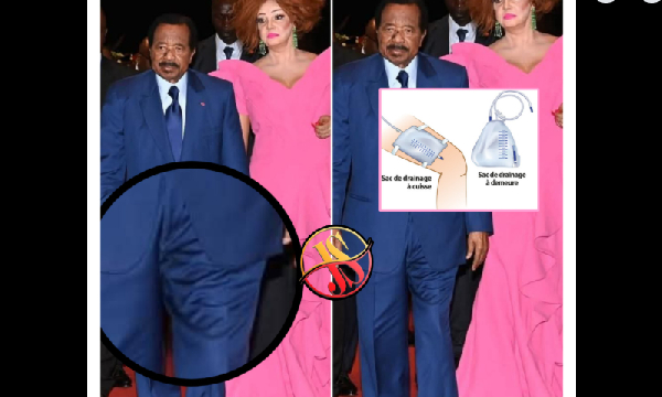 Paul Biya sac de drainage d'urine