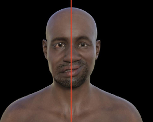 Reconnaitre quelqu'un qui fait un AVC