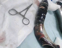 L'objet était coincé dans les fesses de la jeune dame