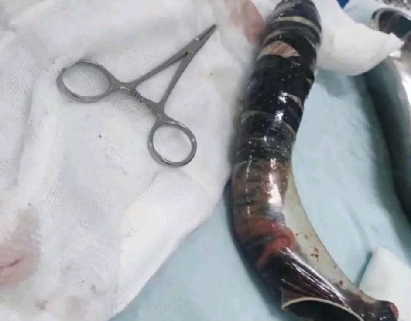 L'objet était coincé dans les fesses de la jeune dame