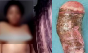 Elle est arrivée aux urgences avec un manioc coincé entre les cuisses