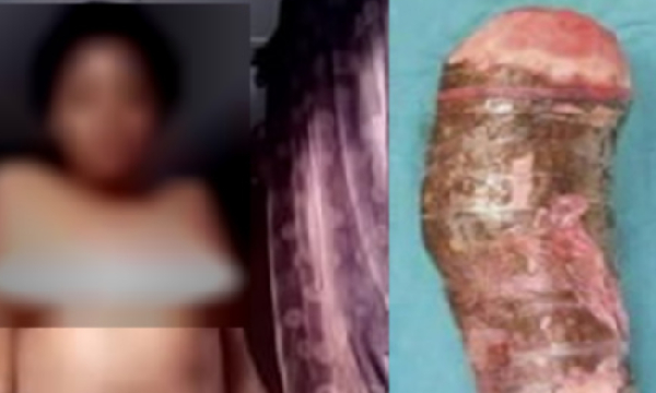Elle est arrivée aux urgences avec un manioc coincé entre les cuisses